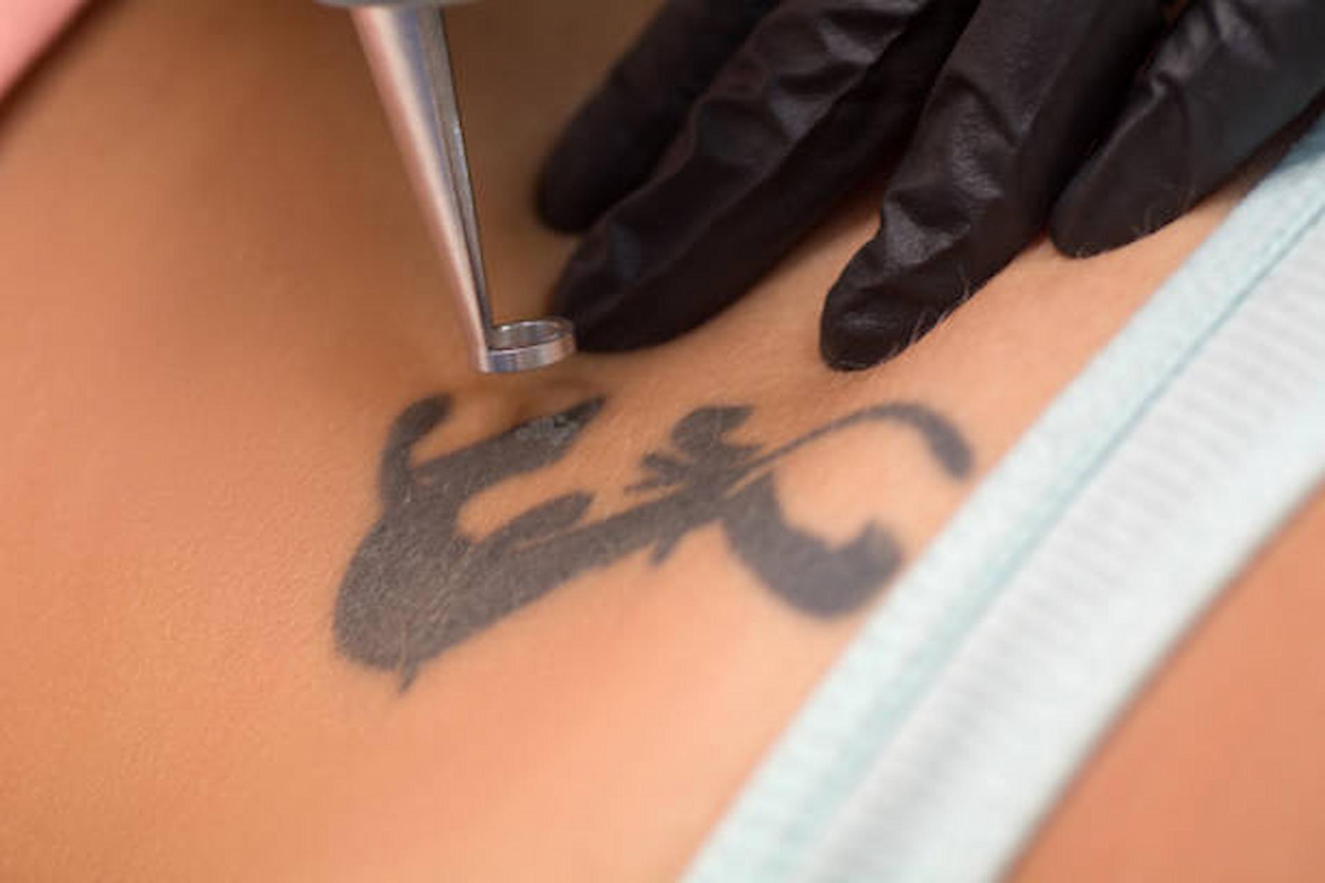 How Long Is A Tattoo Removal Session?